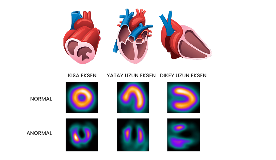 Kalp Sintigrafisi Nedir?